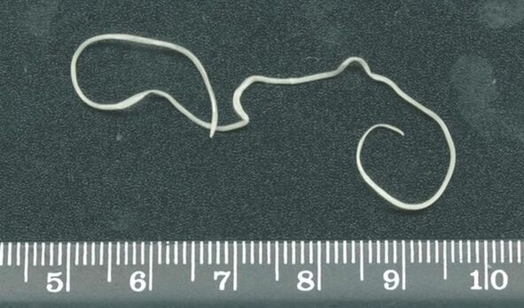 Female heartworm removed under the skin